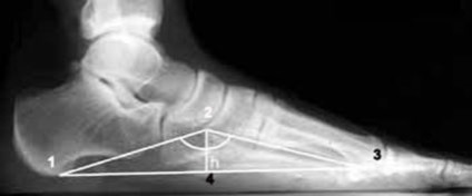 X-sugarak a láb és a holding (X-ray) X-sugarak a láb és a gazdaság
