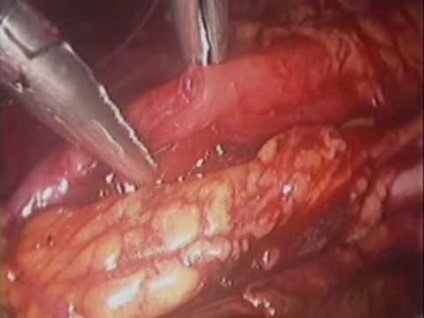 Retroperitoneális fibrózis (Ormond-betegség) - Causes, tünetek és kezelés (fibrózis) Retroperitoneális fibrózis (Ormond-betegség) - Causes, tünetek és kezelés