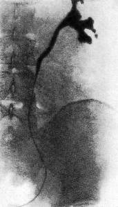Retroperitoneális fibrózis (Ormond-betegség) - Causes, tünetek és kezelés (Ormond) Retroperitoneális fibrosis (Ormond-betegség) - Causes, tünetek és kezelés
