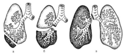 Lung reszekció - olvasás, holding, szövődmények