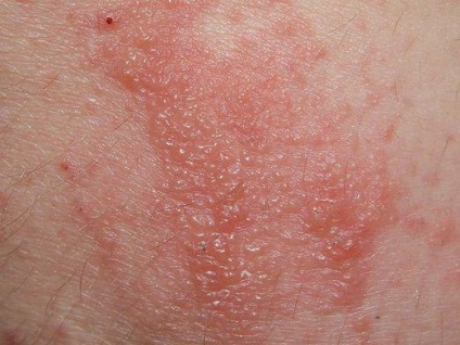 Seborrhoeás dermatitis kezelés gyógyszerek, kenőcsök, krémek és vitaminok (bőr fej) Seborrhoeás dermatitis kezelésére készítmények, kenőcsök, krémek és vitaminok