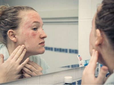 Seborrhoeás dermatitis a tünetek és a kezelés az arc, kenőcs, krém