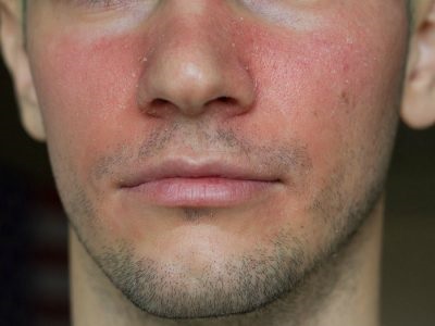 Seborrhoeás dermatitis tünetek és a kezelés az arc, kenőcsök, lemosószerek (seborrheás dermatitis arc) Seborrhoeás dermatitis a tünetek és a kezelés az arc, kenőcs, krém