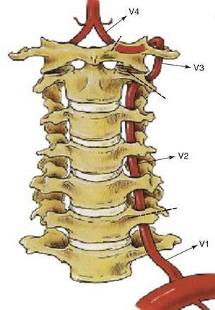 A szindróma artéria vertebralis a nyaki osteochondrosis tünetek és kezelés