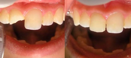 Fény tömések elülső fogak fotó, jelzések, a kezelés