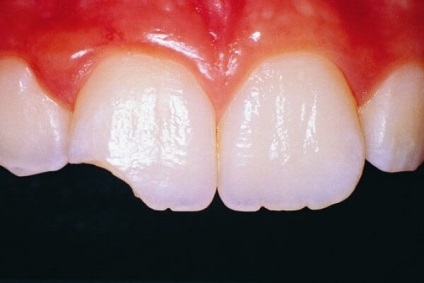Fény tömések elülső fogak fotó, jelzések, a kezelés