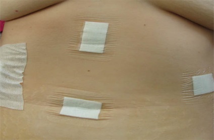 Thrombosis, béltüneteik, megfelelő kezelés és a megelőzés (betegség) Thrombosis, béltüneteik, megfelelő kezelés és a megelőzés
