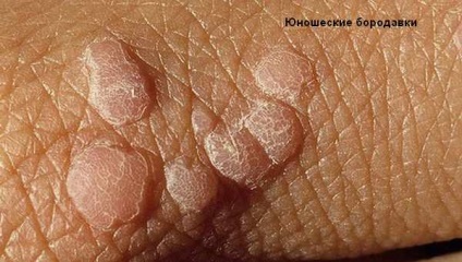 Ezzel szemben, mint kondilomáknak és papilloma és hogyan kezelik őket megfelelően (lézer) Mi a különbség a szemölcs és papilloma, és hogyan kell helyesen kezelni