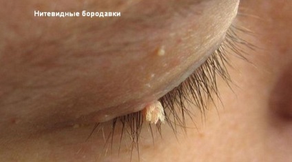 Mi a különbség a szemölcs és papilloma, és hogyan kezelik őket megfelelően (kenőcsök) Mi a különbség a szemölcs és papilloma, és hogyan kell helyesen kezelni