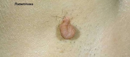 Ezzel szemben, mint kondilomáknak és papilloma és hogyan kezelik őket megfelelően (eltávolítás) Mi a különbség a szemölcs és papilloma, és hogyan kell helyesen kezelni