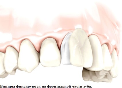 Típusú héjak - mik a (kerámia, kompozit, porcelán) és mi a legjobb