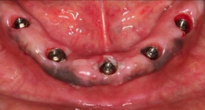Lehetséges szövődmények után fogászati ​​implantátumok