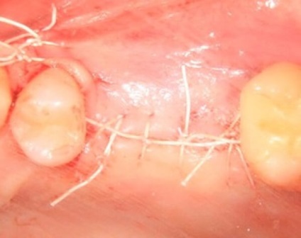 Lehetséges szövődmények után fogászati ​​implantátumok