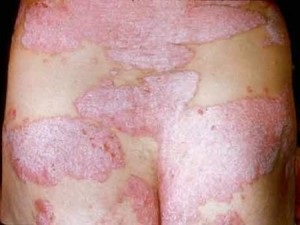 Vulgáris psoriasis mi ez, a pikkelysömör kezelésében