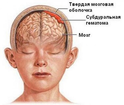 Krónikus, akut subduralis haematoma, agyi hatásait a műtét után, hogy távolítsa el
