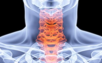 Betegségek a nyaki gerinc, égő és a gyulladás a nyaki izmok okoz, a tünetek, a kezelés