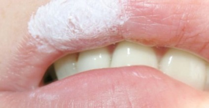 Fogkrém herpesz az ajkakon és a kezelés hatékonyságát