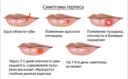 Fogkrém Herpes az ajkak kezelésére, ha ez segít (ajak) Fogkrém Herpes az ajkak kezelésére, ha ez segít