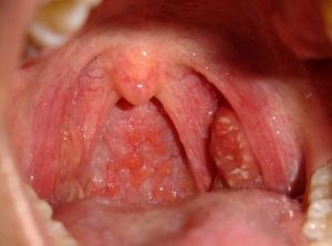 Allergiás pharyngitis tünetei és kezelése