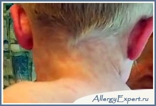 Алергія на папуг, симптоми у дітей і дорослих