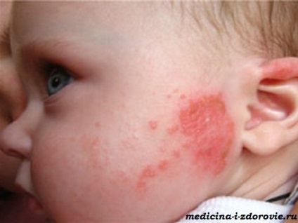 Allergiás tünetek hal, a gyermekek, a kezelés