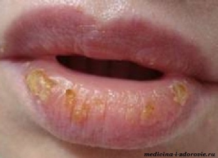 Allergiás tünetek hal, a gyermekek, a kezelés