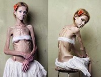 Anorexia mi ez és miért veszélyes (módosítás) Anorexia mi ez és miért veszélyes