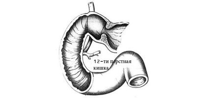 Atrófiás gasztritisz duodenitis - tünetek és kezelés