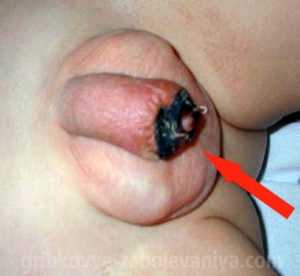 Balanitis (candidiasis) a gyermek okoz, tünetei, kezelése