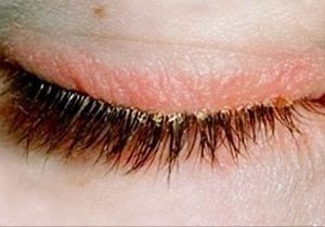 Blepharitis tünetek és kezelések, fotó allergiás betegség formájában
