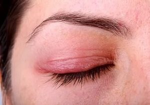 Blepharitis tünetek és kezelések, fotó allergiás betegség formájában