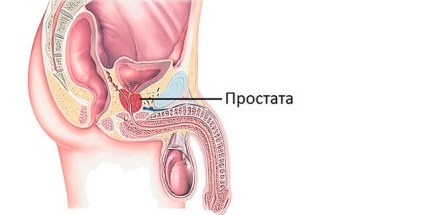 Prosztatagyulladás és coccyx - Pollen hatású prostatitis, Prosztatilen erekció