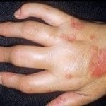Ízületi fájdalom az ujjak okoz, és fájdalom kezelésére