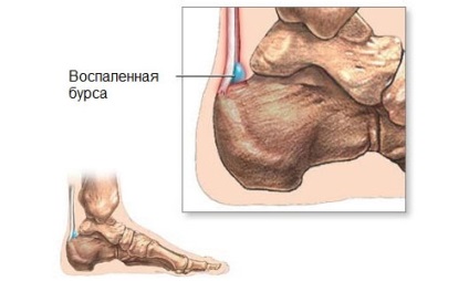 Burzitiszt a sarok (sarok, podpyatochny) mi az, okok, tünetek, kezelés, népi jogorvoslati