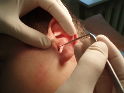 Cernye dugók a füle miért van és hogyan kell harcolni (tinnitus) nekik Cernye dugók a füle van, miért van, és hogyan kell kezelni őket