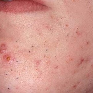Az arc bőrén élő paraziták - Rovarok és élősködők okozta bőrbetegségek - Bőr alatt élősködő
