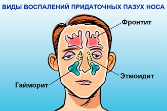 Що робити якщо болить голова при нежиті - причини і лікування