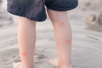 Mi köze a rovarcsípés, hogyan lehet megszabadulni az allergia, mik a tünetek
