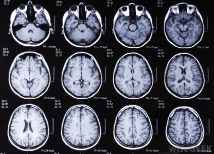 Mit és miért agyi MRI