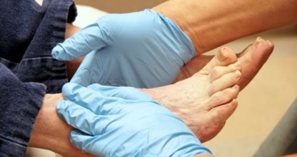 trofikus fekélyek diabetes mellitus seb lábak és a kezelés