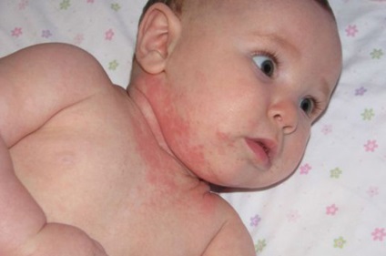 Dermatitis újszülött grudnichka külleme, tünetek, kezelés (tünetek) Dermatitis újszülött grudnichka külleme, tünetek, kezelés