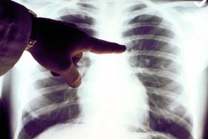Egy nagy tüdőgóc sem mindig daganat | Dr. Székely András