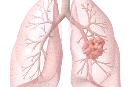 Jóindulatú daganat tüdő leírás és a kezelés