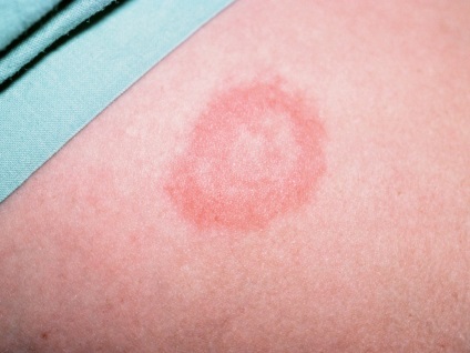 Erythema újszülöttek vagy kezelésére bőrkiütések