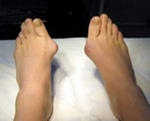 Ha megelőzése hólyagok és duzzanatok a láb - kezelésére emberek jogorvoslatok