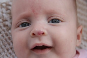 Hemangioma az orr, a baba fotó és mi az, hogy miért van