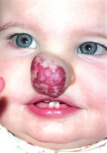 Hemangioma az orr, a baba fotó és mi az, hogy miért van