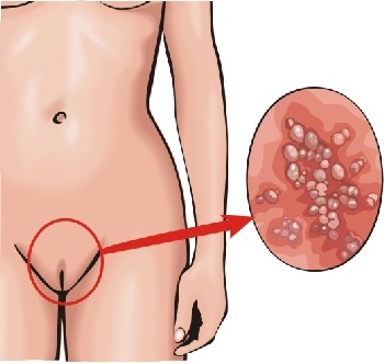 A genitális herpesz népszerű kezelések