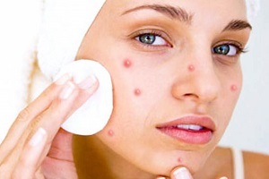 Gennyes pattanások az arcon, okai és kezelése gennyes