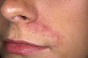 Gennyes pattanások az arcon, okai és kezelése gennyes